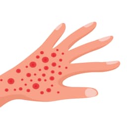 Allergy