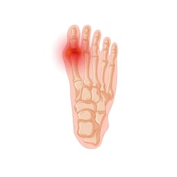 Gout