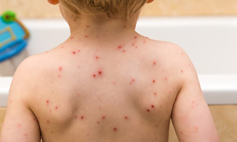 ‌ကလေးများတွင် အဖြစ်များသည့် ရေကျောက် (Chickenpox)